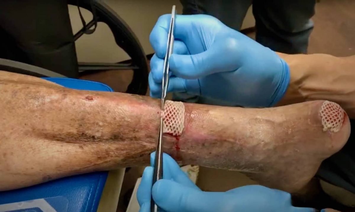 Allograft biologic application