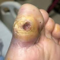 Diabetic foot wound care