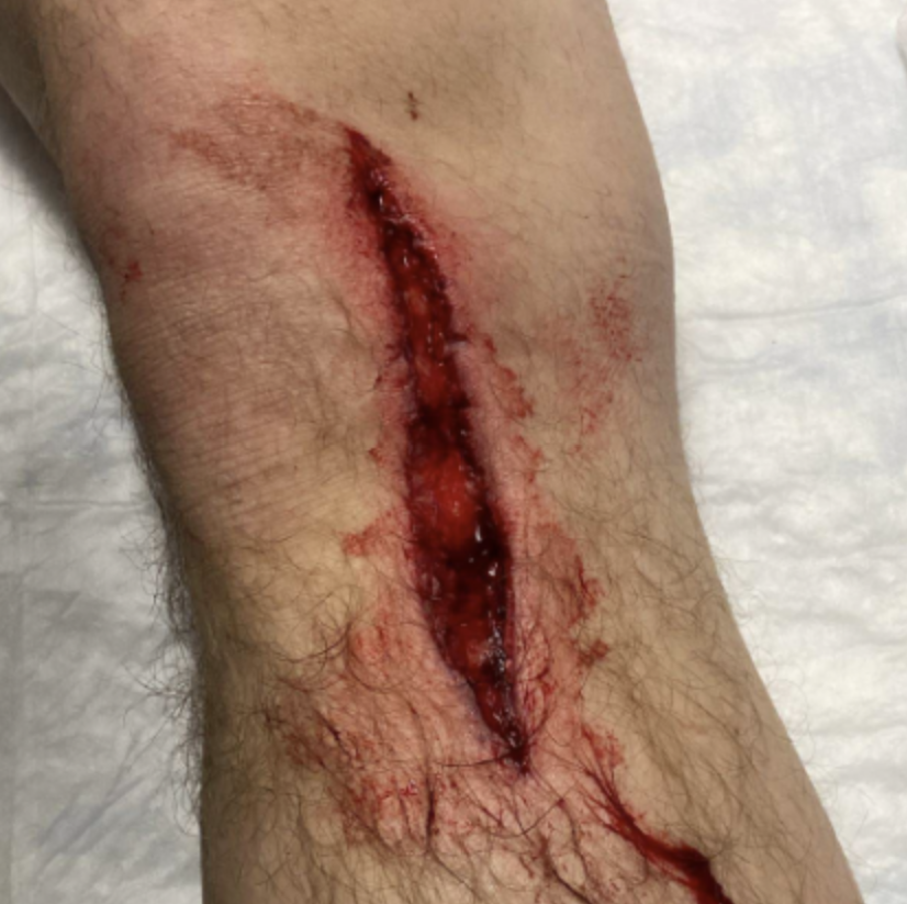 Traumatic wound care